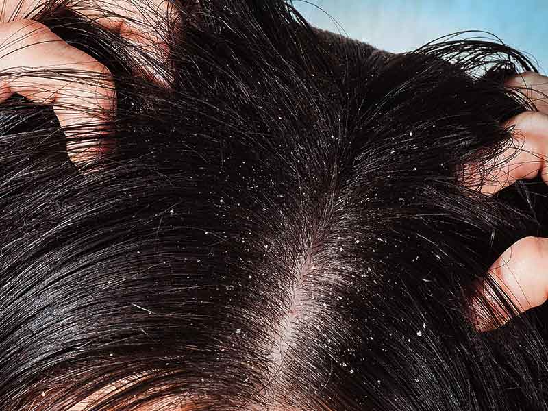 dandruff