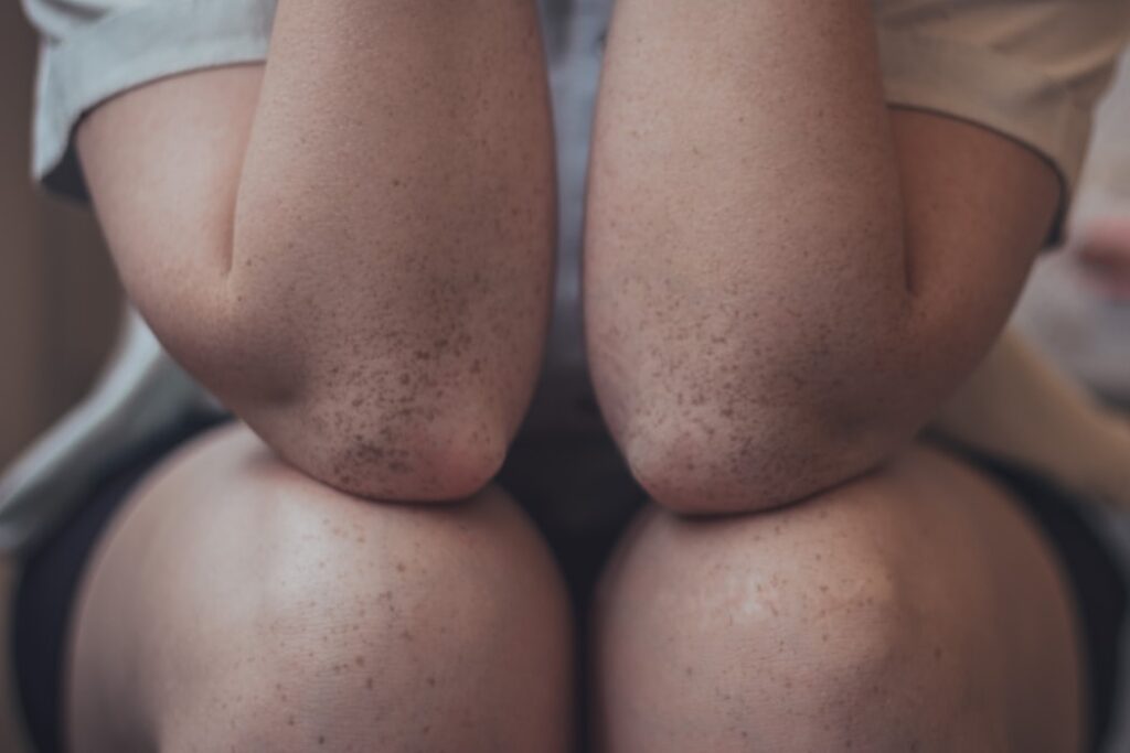knees and elbow with freckles and dark spots
