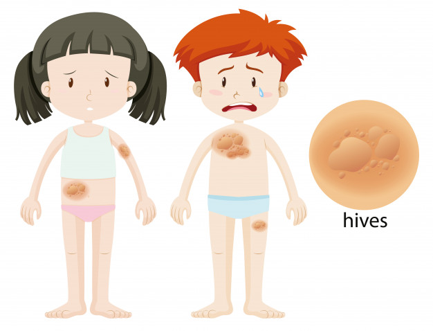 hives and skin irritation on skin