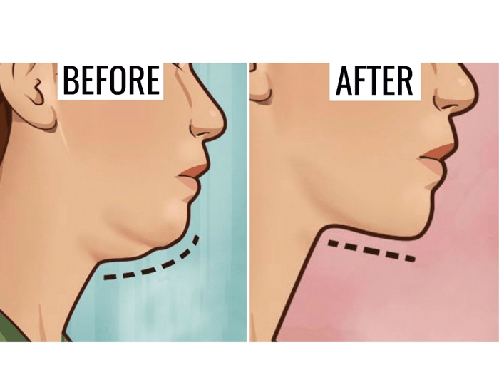 get rid of a double chin