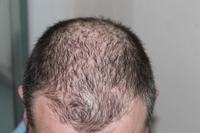 Hair Loss in Teenage Guys