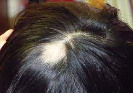 image 3 Overview on teenage hair loss