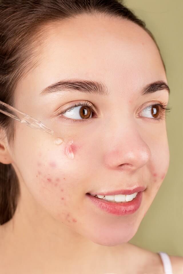 serum for acne-prone skin
