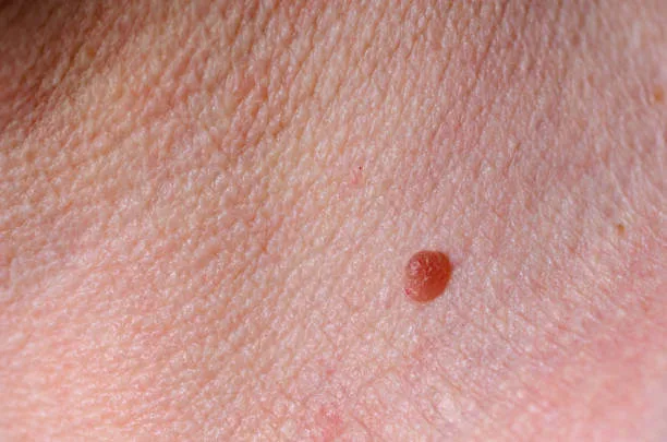 skin tags