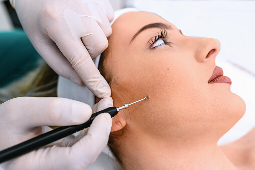 treatments for skin tags